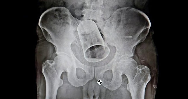 Doctors have removed a steel cup from a man's bottom - after his friends put it up there as a drunken prank. See SWNS story SWFSsteel. The 45-year-old from Balipadar, India, had the substantially sized tumbler removed via surgery at a local hospital. The incident, which took place 19 August, happened when the unfortunate man was out drinking with his friends in Surat, Gujarat. According to reports, the victim's 'friends' inserted the sizeable item up his anus whilst he was in an ''inebriated state''. An X-Ray was done at MKCG Medical College and Hospital at Berhampur city, and the glass was found stuck in the intestine. At first, the doctors tried to retrieve the glass through rectum but then resorted to surgery due to the sheer size of the glass. Doctors had to cut through the intestine to retrieve the object. The unlucky man is recovering after the surgery and his condition is said to be stable.