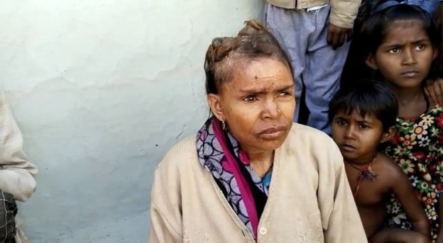 Doctors have been left stumped after HORNS started growing out of a woman's head in India. See SWNS story SWNAhorns. Mimiya Bai, 60, started growing horns out of her head three years ago resulting in unbearable pain. Mimiya said that people did not believe her when she told them of her ailment and were 'surprised' when they saw her. She is now waiting for treatment and in consultation with senior doctors but her condition has been described as 'beyond their understanding'.