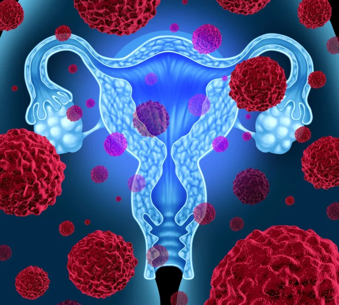 Uterine Endometrial Cancer Therapy Concept