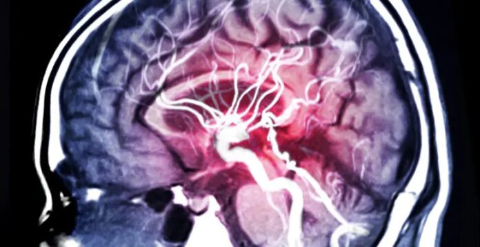 MRI Scan Brain Hemorrhage